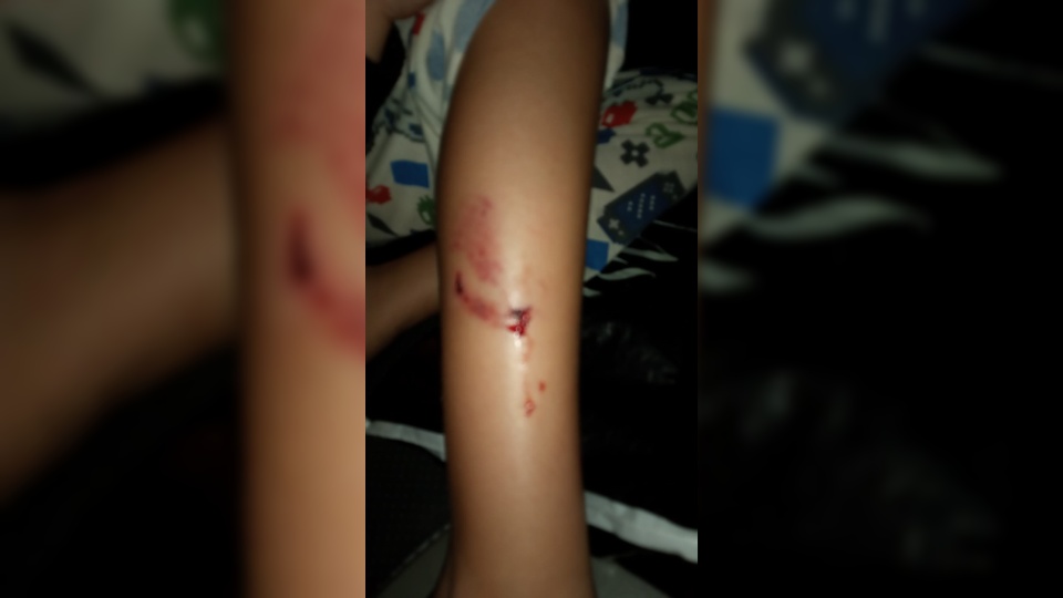 Criança de sete anos é mordida por cachorro de rua em Teixeira