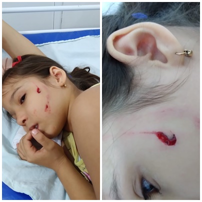 Menina é atacada por cão de rua e tem rosto mordido pelo animal, no bairro Jatobá, em Patos