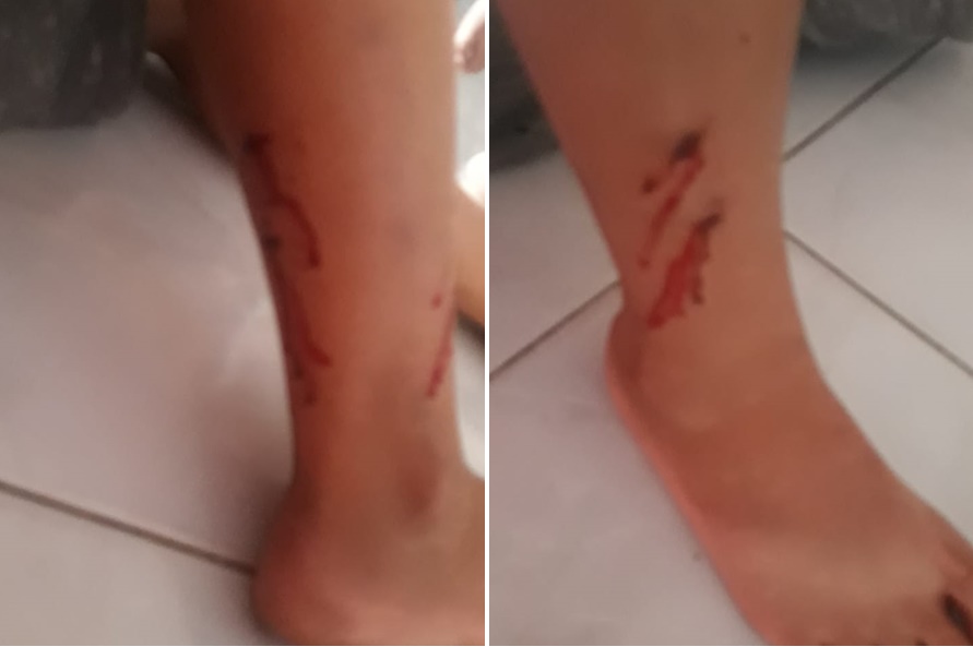 Mais um caso: Garoto de 12 anos foi atacado por cães em Patos