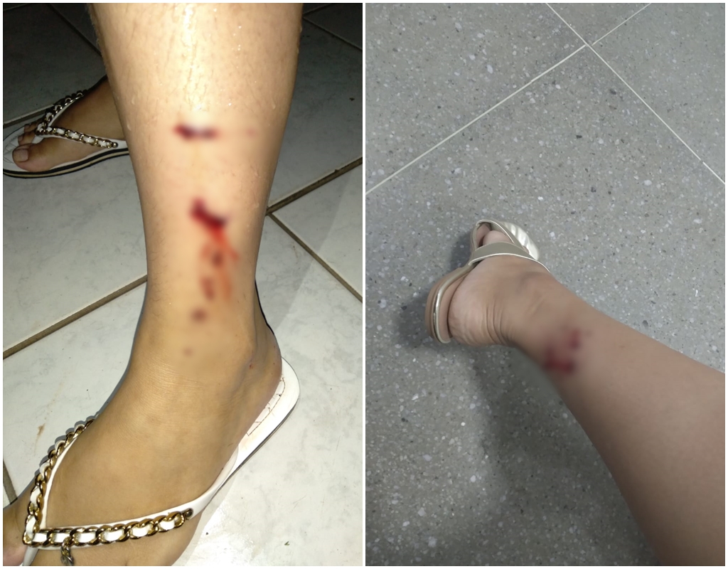 Mulher é atacada por cães de rua em Patos e pede providências à prefeitura: “eram sete ou oito e um deles me atacou por trás”