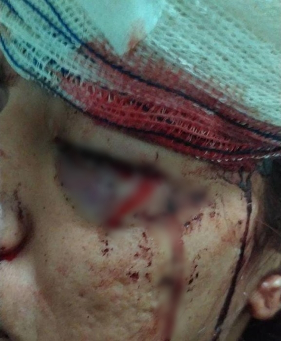 Mulher é agredida com barra de ferro pela vizinha durante festa de aniversário, na Paraíba