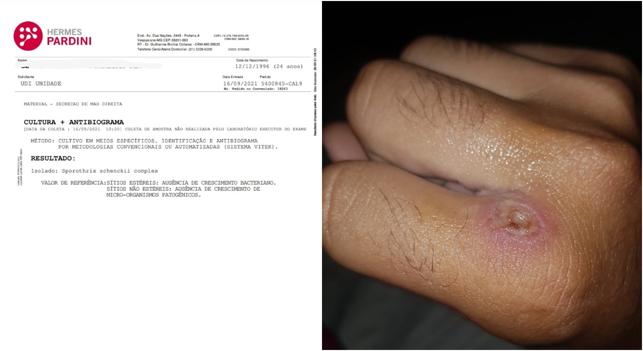 Primeiro caso de doença contagiosa e transmitida por animais de rua é registrada em Patos