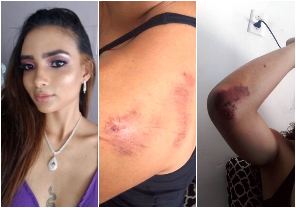 Novo ataque de cães deixa jovem bastante ferida em Patos; vítima caiu da moto e sofreu escoriações