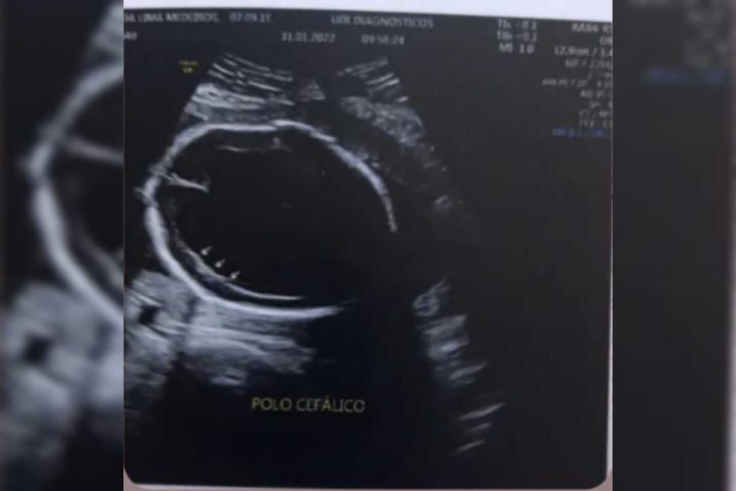 Patoense grávida de 5 meses está realizando campanha para custear procedimento de retirada de líquido do cérebro do bebê, que custa R$ 3.500,00