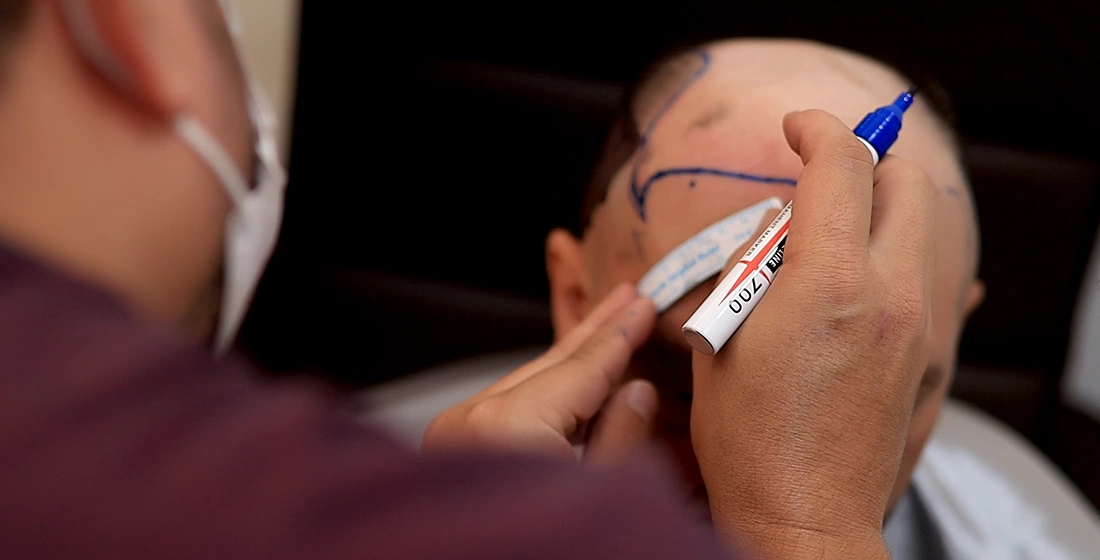 Em Patos: Hospital Day realiza seu primeiro transplante capilar