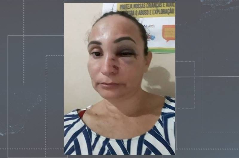 Com rosto machucado, mulher denuncia agressões de ex-marido em Igaracy. Vídeo