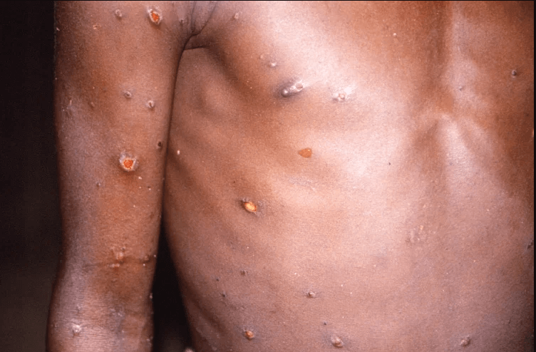 Brasil investiga dois casos suspeitos de varíola dos macacos; um deles no Nordeste