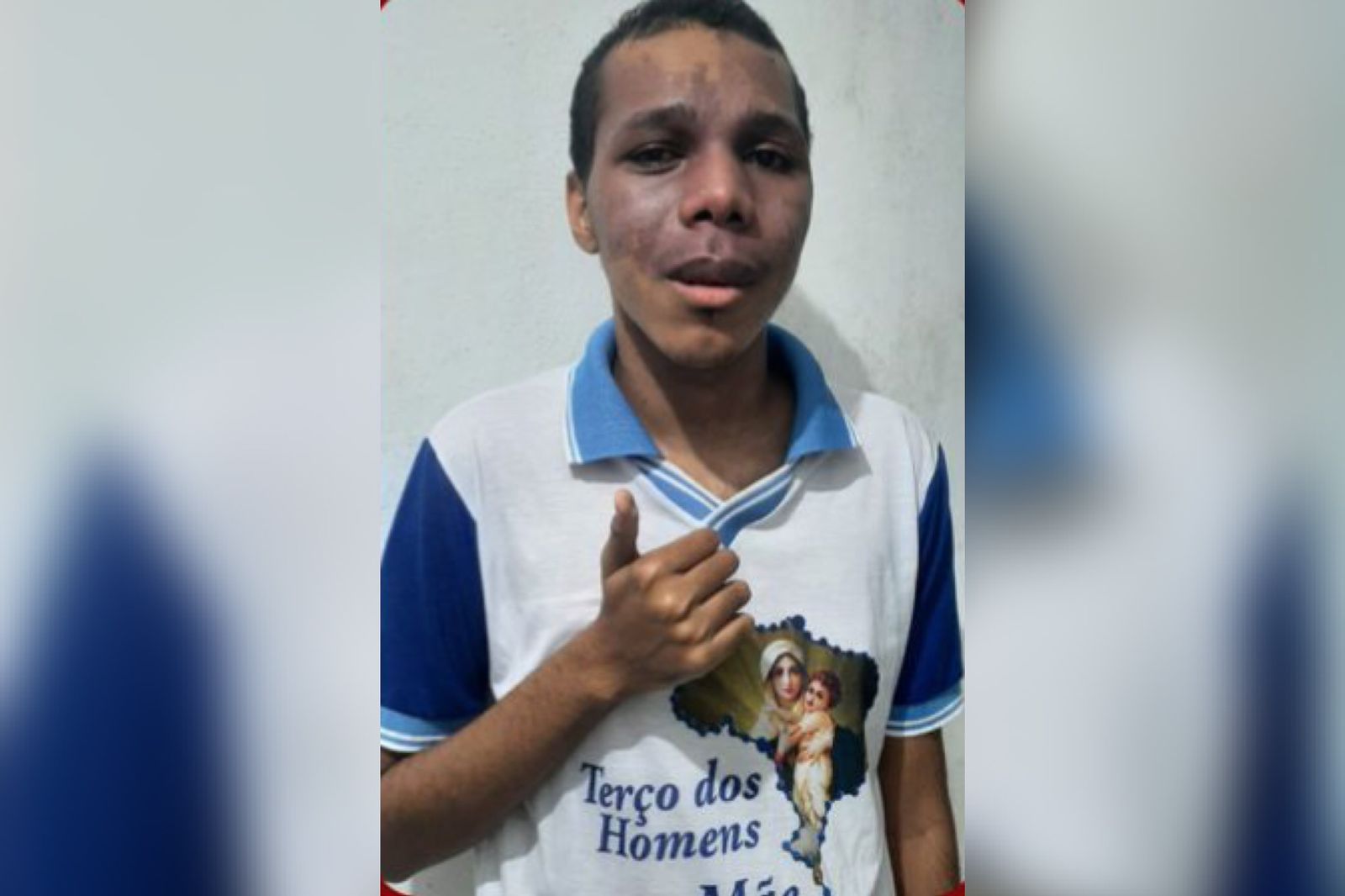 Jovem estudante de Engenharia Civil que foi diagnosticado com Glaucoma está realizando campanha para custear cirurgia no valor de aproximadamente R$ 7.000,00. Veja como contribuir