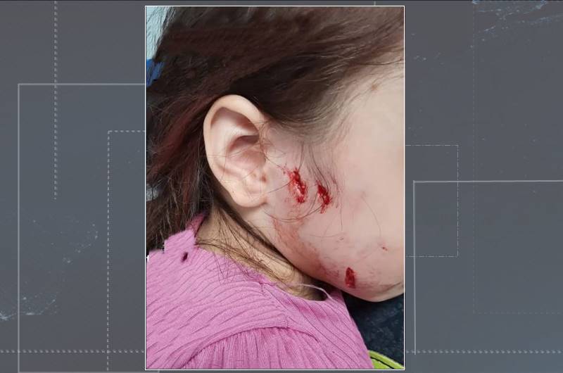 No Sertão: Criança de três anos é atacada no rosto por cachorro vira-lata