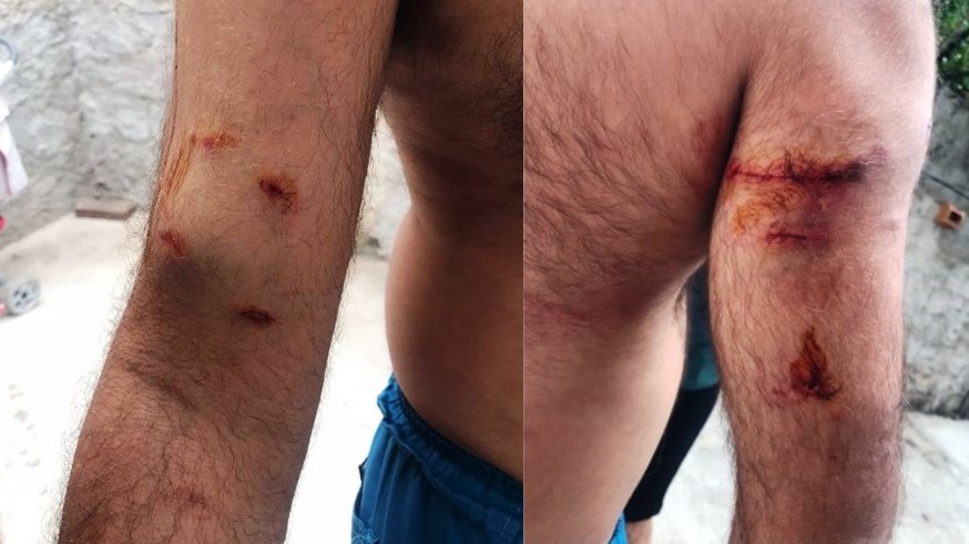 Em Patos: Servidor da Cagepa é atacado por cães de rua e fica bastante ferido