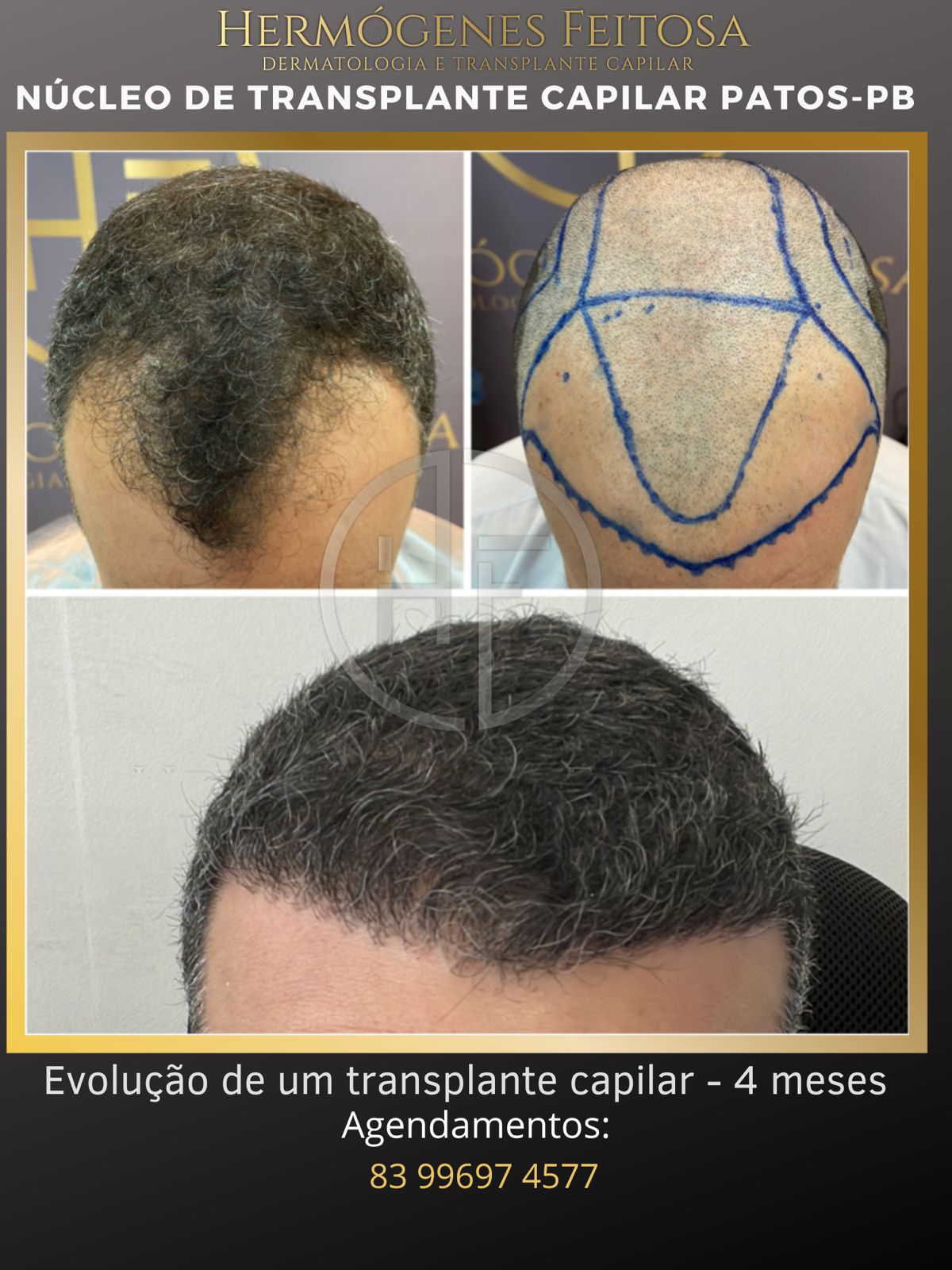 Núcleo de Transplante Capilar, coordenado pelo médico Dr. Hermógenes Feitosa, vem colocando Patos-PB como referência no tratamento da calvície. CONFIRA