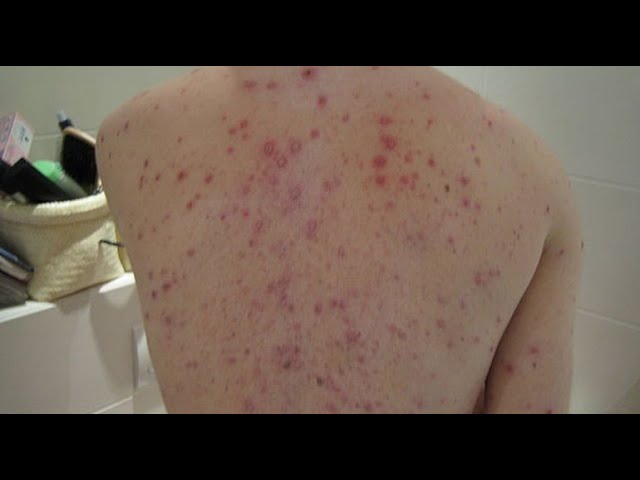 Número de casos em investigação da Varíola dos macacos aumenta para 21 na Paraíba, um deles no Sertão