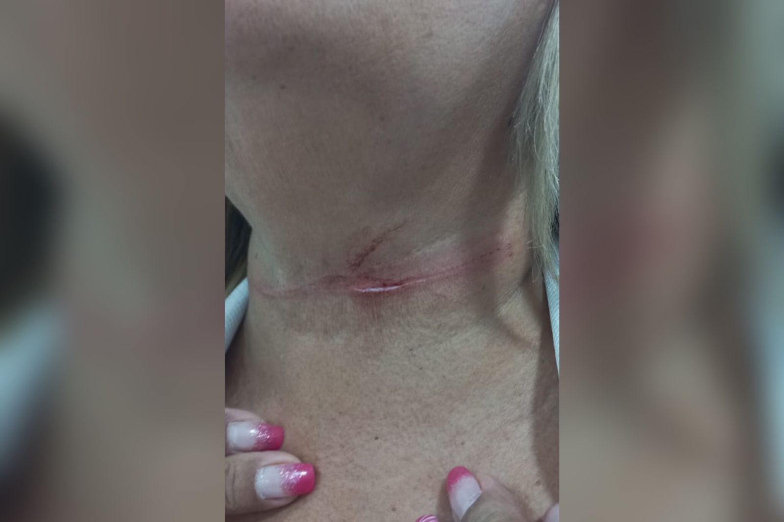 Acidente: Cidadã patoense tem pescoço ferido por linha de cerol para soltar pipas