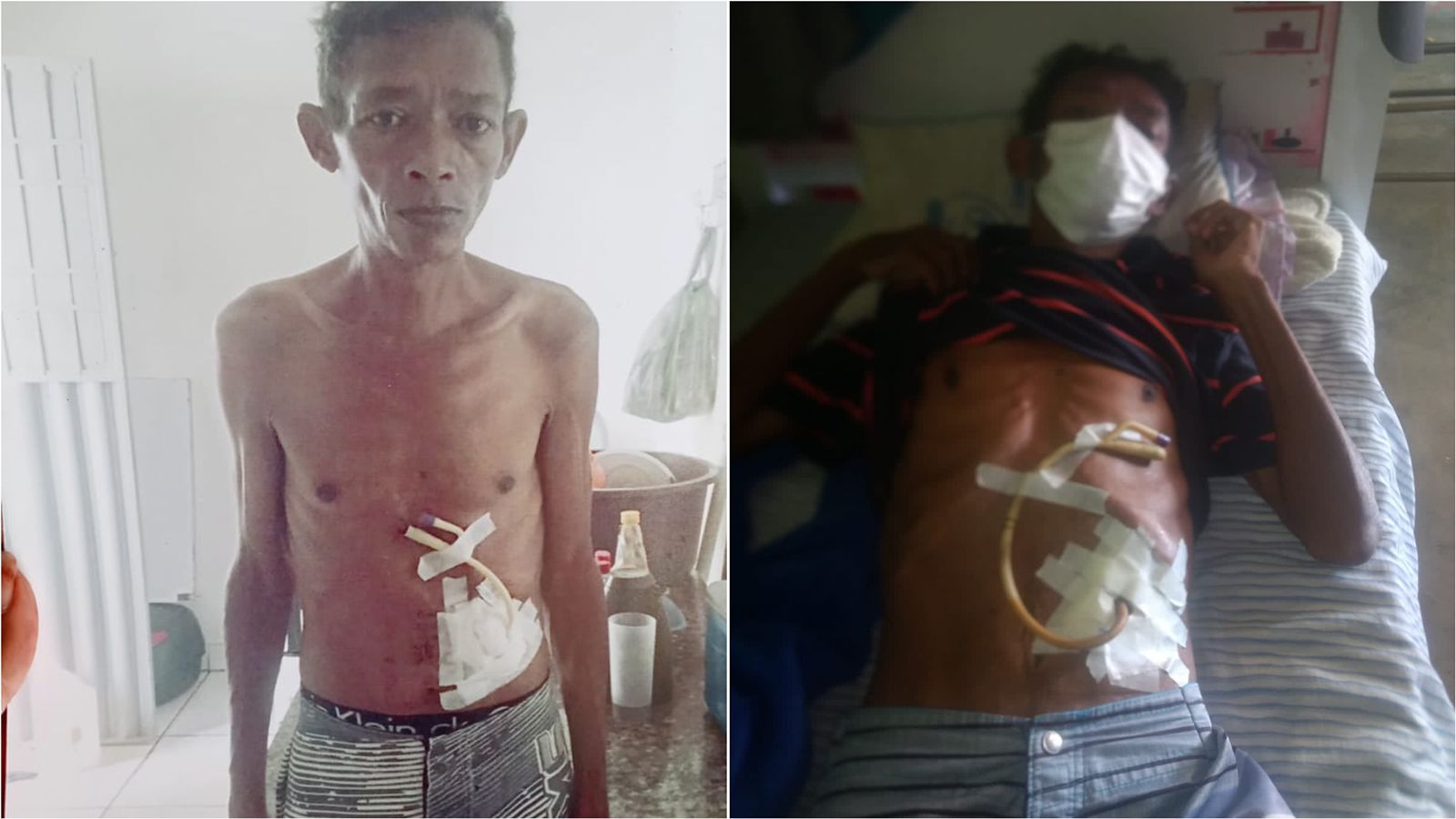Em Patos: homem acometido com câncer de estômago passa por dificuldades financeiras e pede ajuda para alimentação