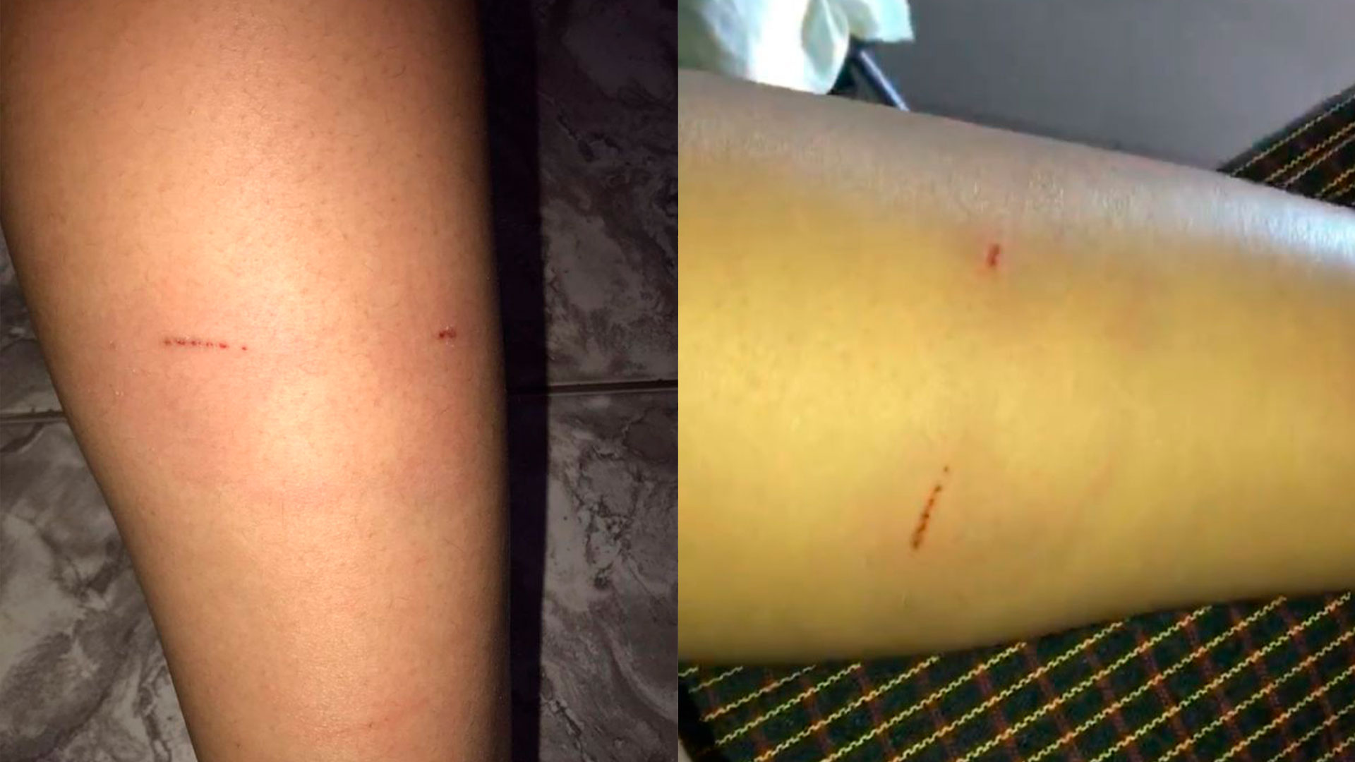 Trabalhadora é mordida por cães de rua quando retornava do trabalho, no centro de Patos