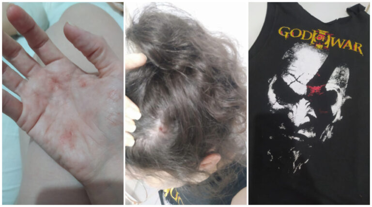 Professora de Patos sofre pedrada na cabeça após ter camiseta de personagem confundida com foto de político, em Sapé