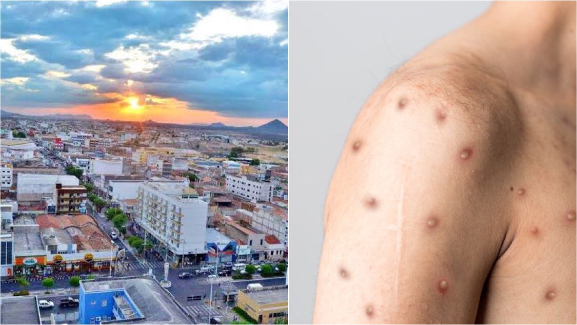 Secretário de Saúde comenta caso confirmado de varíola dos macacos em Patos e diz que paciente está bem. OUÇA