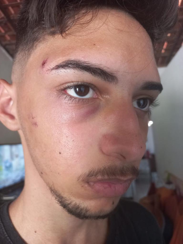 Família relata que adolescente de 16 anos foi agredido na saída da escola, em Malta, e precisou passar por cirurgia no rosto