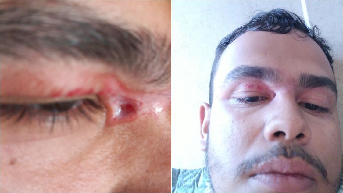 Motociclista relata que foi atingindo por corda no rosto próximo ao Mercado Público de Patos e quase sofreu grave acidente