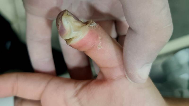 Em Patos: Criança de 10 anos sofre descarga elétrica em carregador de celular e tem queimaduras de segundo e terceiro graus, na tarde deste sábado (12)