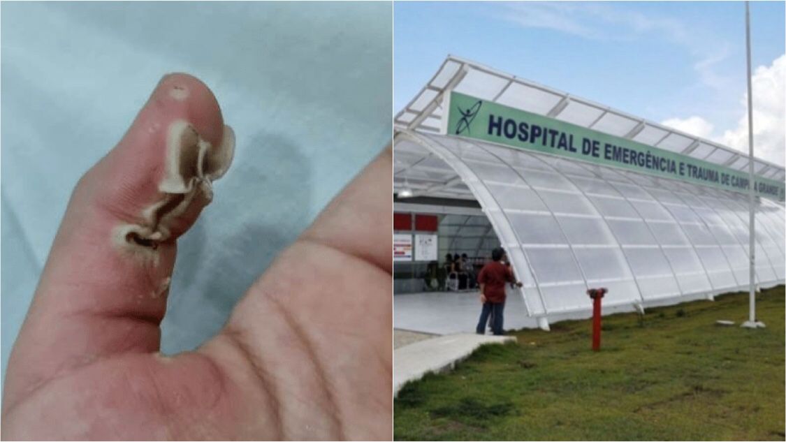 Criança que sofreu queimaduras após descarga elétrica em carregador, em Patos, é transferida para o Hospital de Trauma de Campina Grande. OUÇA