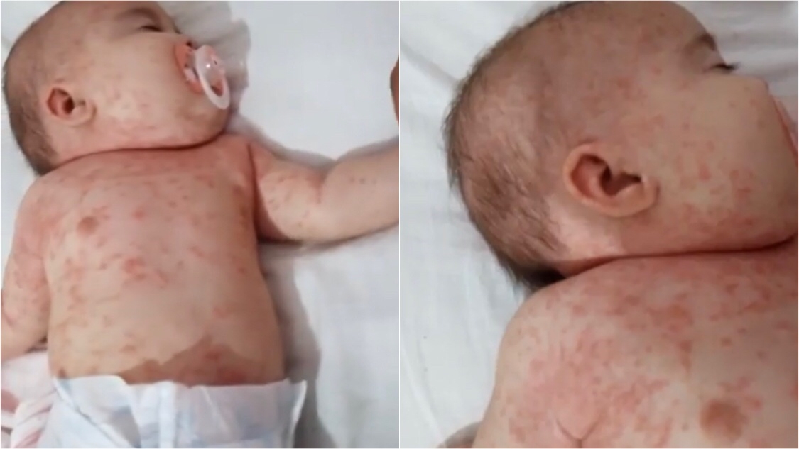 Em Patos: Mãe de bebê de 3 meses com suspeita de dermatite atópica faz campanha para conseguir realizar consulta com dermatologista. Veja como contribuir