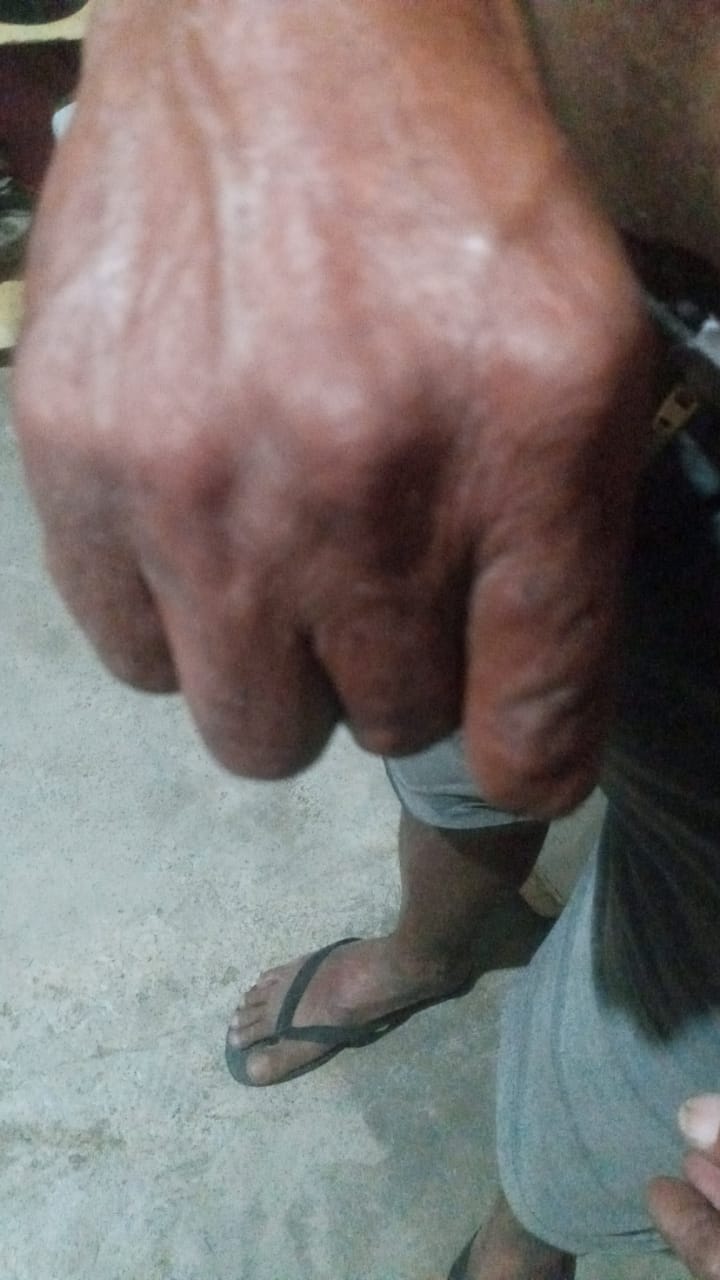 Em São Mamede, homem deficiente pede ajuda para realizar exames de ressonância e conseguir dar entrada no auxílio-doença; veja como contribuir