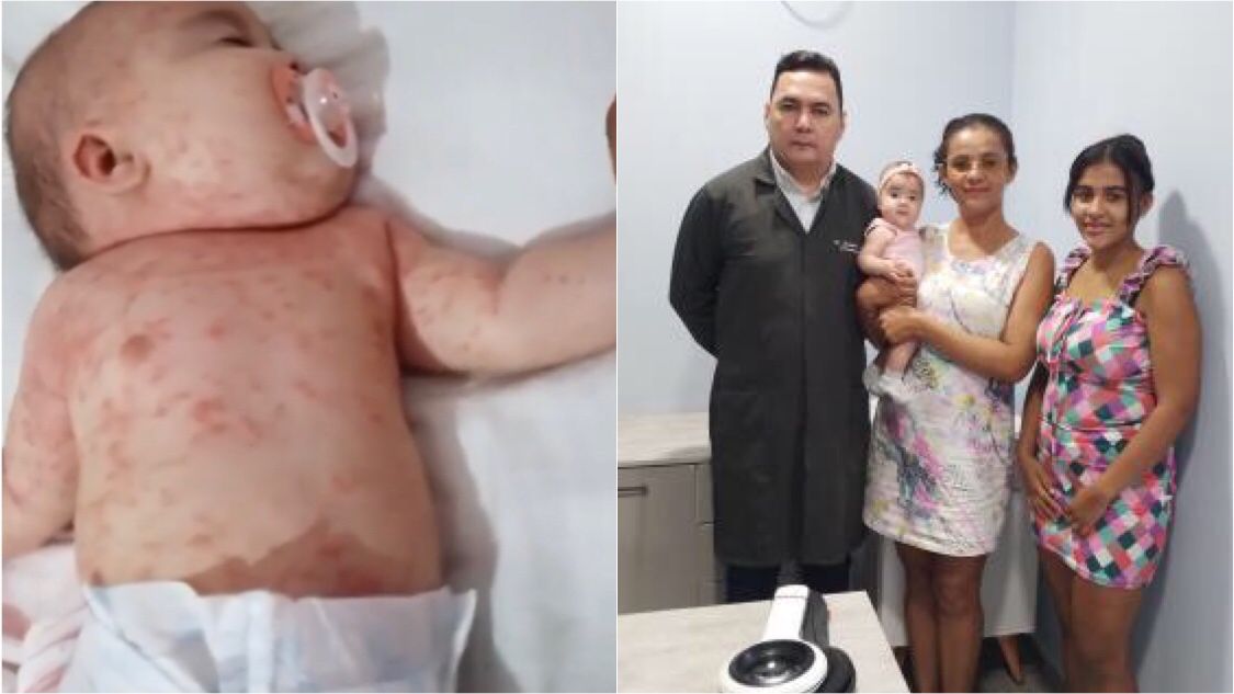Em Patos, bebê que foi diagnosticada com quadro de dermatite atópica segue realizando tratamento e evoluindo bem; mãe pede ajuda para conseguir leite e fraldas