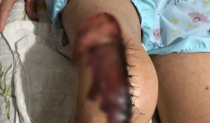 Patoense diagnosticada com câncer na tíbia corre risco de amputação e faz campanha para realizar cirurgia que custa R$ 40 mil; veja como ajudar