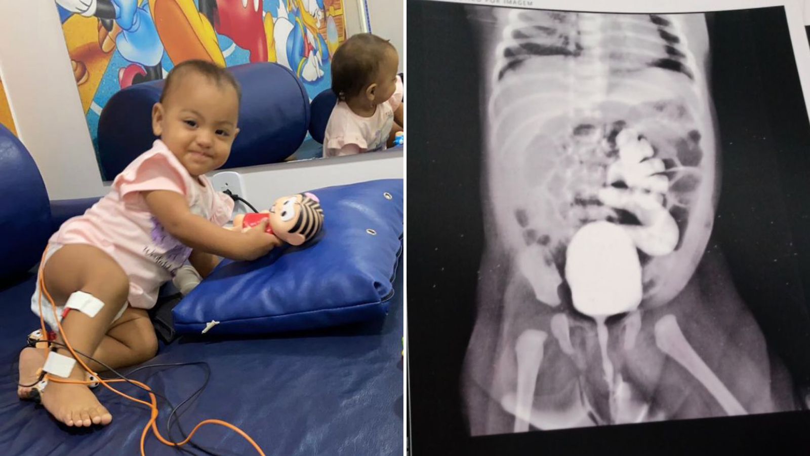 Mãe cria Pix Solidário para custear cirurgia de filha de 2 anos diagnosticada com refluxo vesicoureteral de grau V, que compromete rim, ureter e bexiga; Veja como ajudar