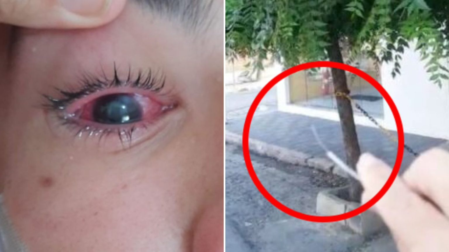 Jovem que teve o olho perfurado por cabo de internet passou por duas cirurgias em Campina Grande e segue em recuperação para recuperar a visão