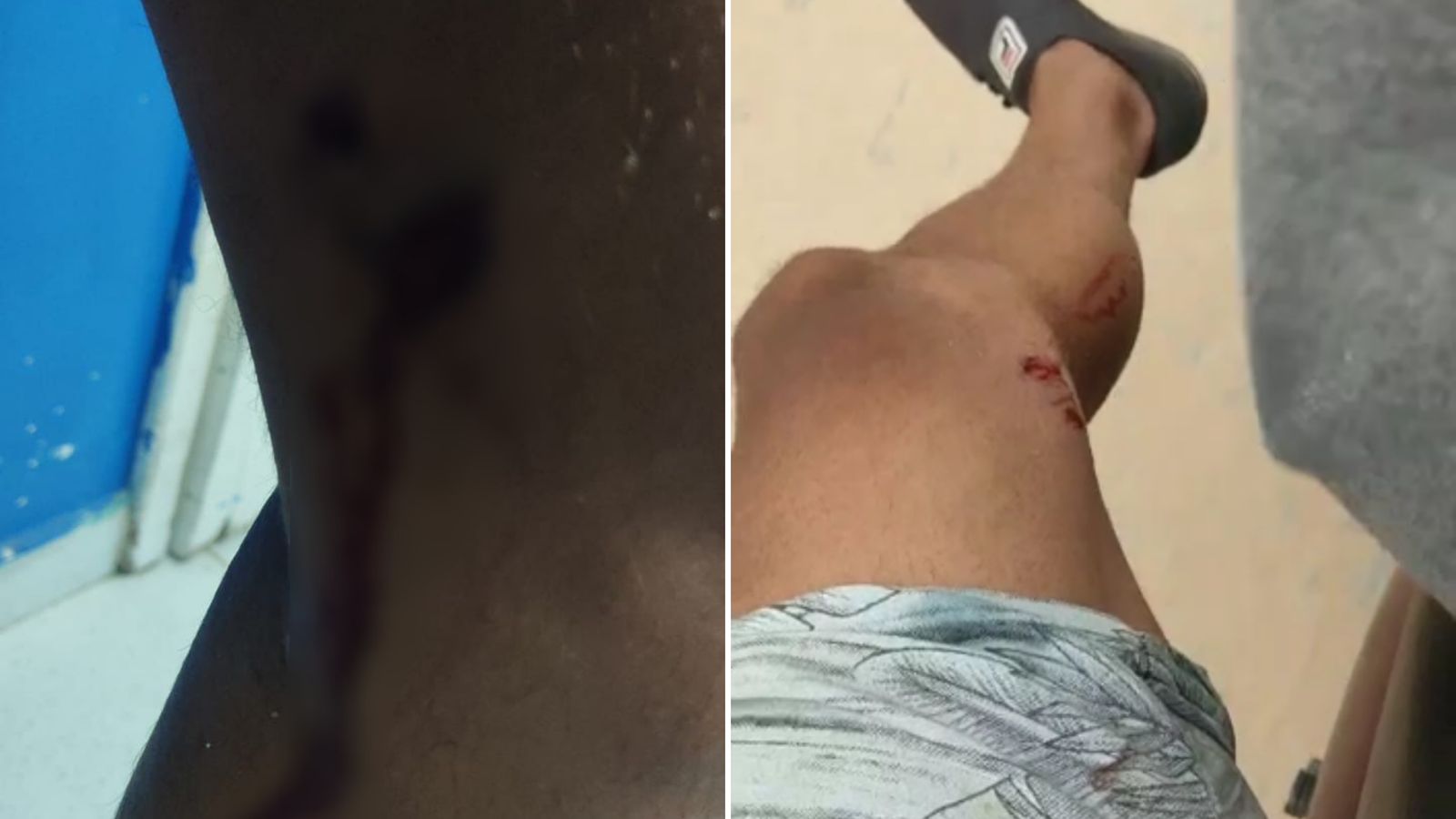 Em Patos, entregador ficará afastado do trabalho por três dias após ser atacado e mordido por cão de rua