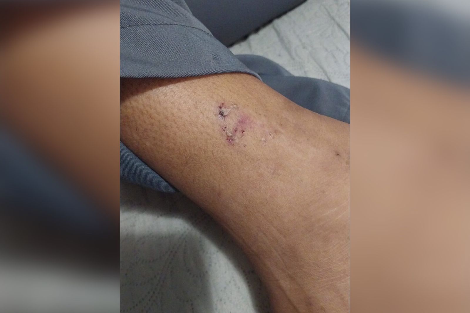 Mulher é mordida por cães de rua enquanto se deslocava para o trabalho, no bairro dos Estados, em Patos