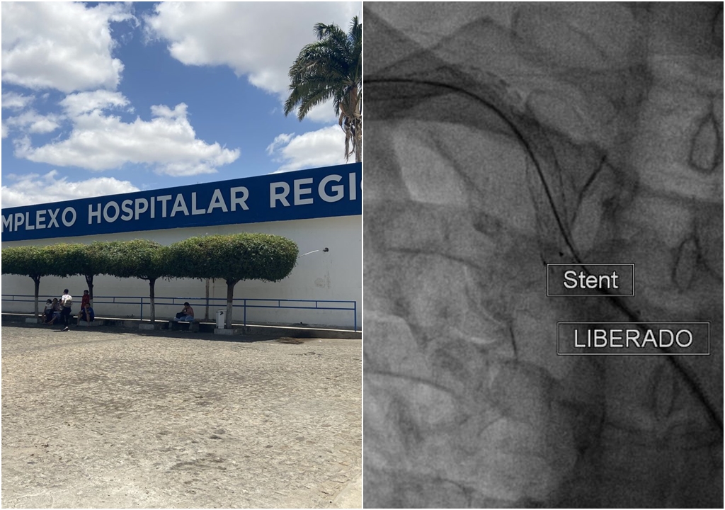 Homem sofre infarto grave e é submetido a cateterismo cardíaco e angioplastia em tempo recorde no Hospital Regional de Patos