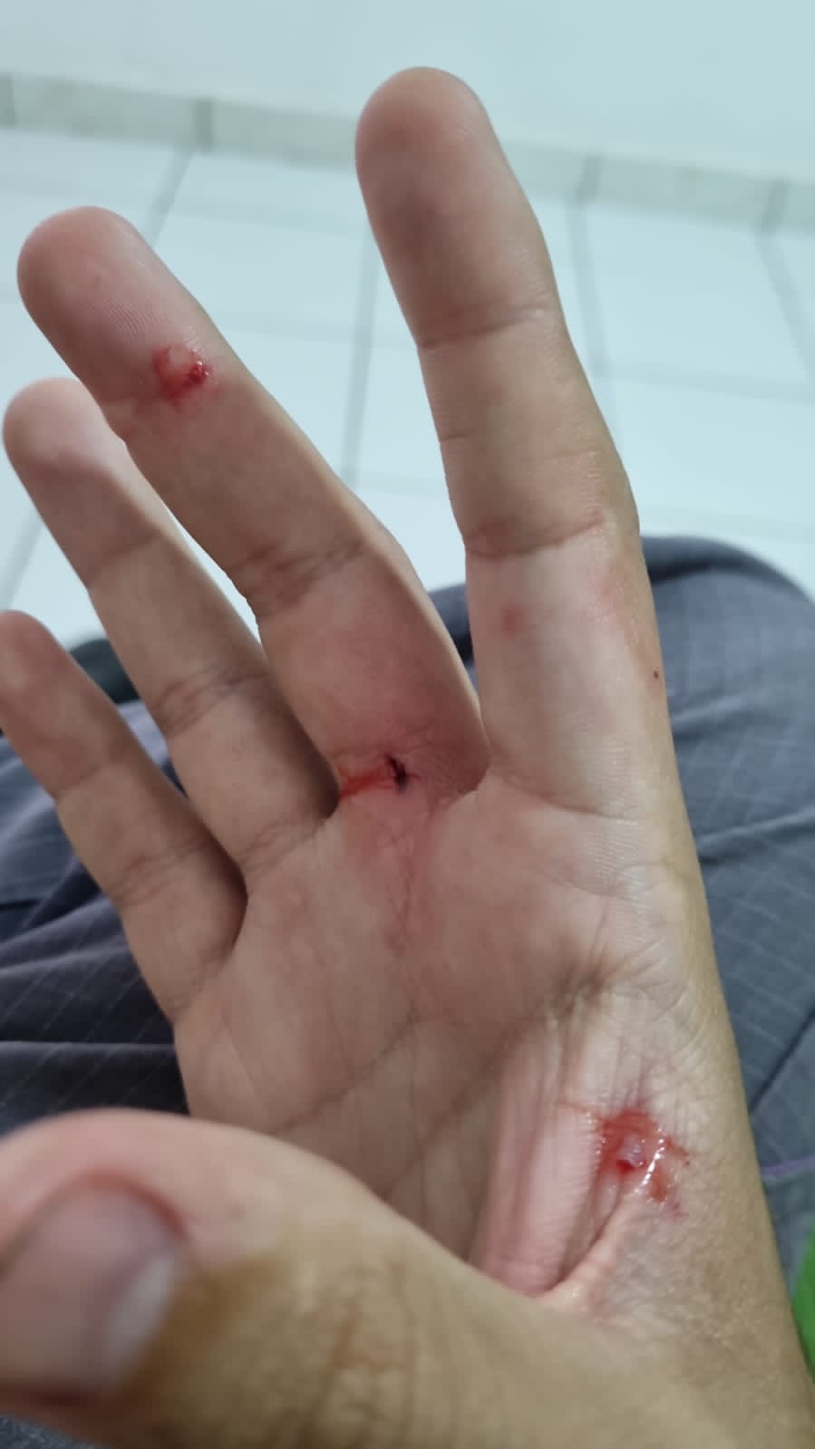 Internauta reclama falta de soro antirrábico no Hospital Regional de Patos após ser atacado por cachorro