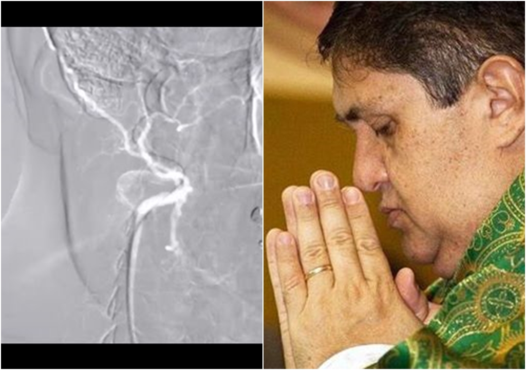 Atualização: Padre José Ronaldo recebeu implante de 2 stents na principal artéria do coração