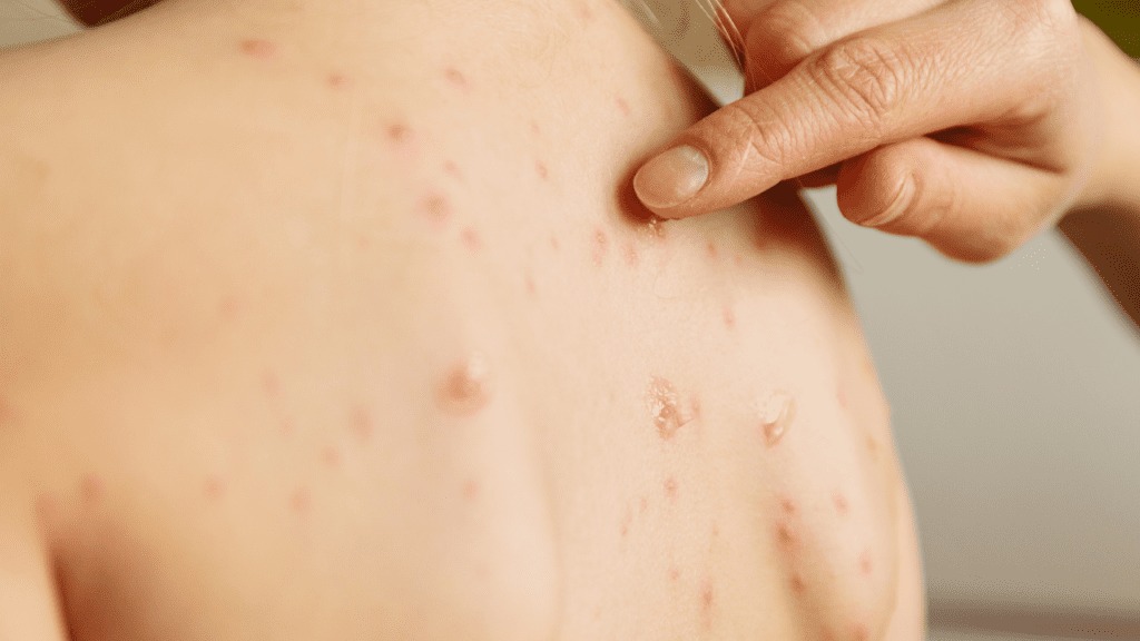 Mãe afirma que alunos de Escola Estadual em São José do Bonfim estão com catapora; Diretor da escola comenta caso