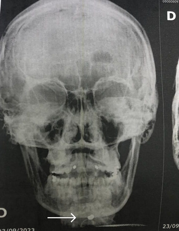 PERIGO: Mulher com criança no colo é ferida no rosto com projétil de pressão de barraca de tiro ao alvo na Festa da Guia, na noite deste sábado (23)