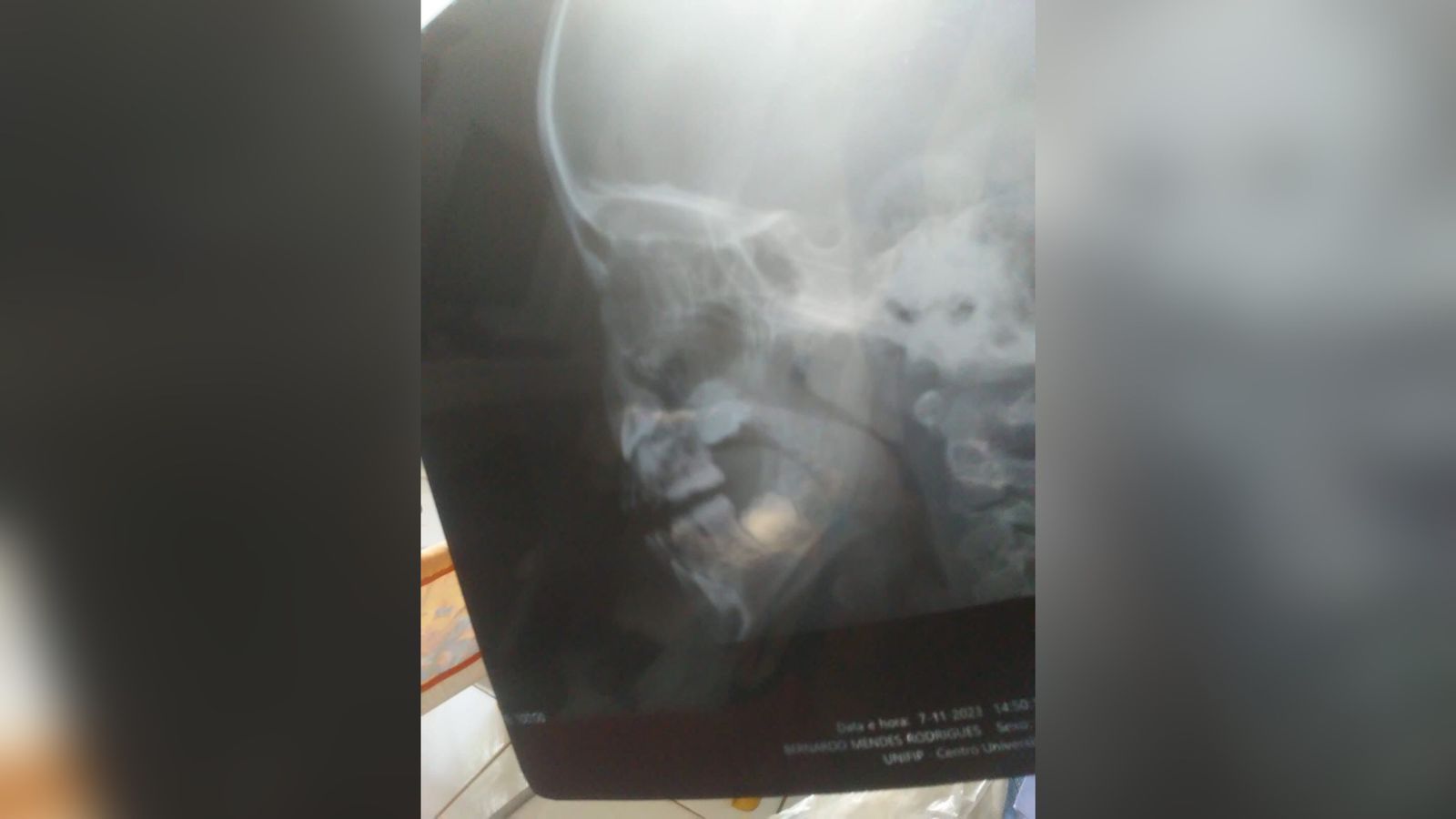 Em Patos: Pai reclama de demora em marcação de cirurgia de adenoide para seu filho de apenas 3 anos