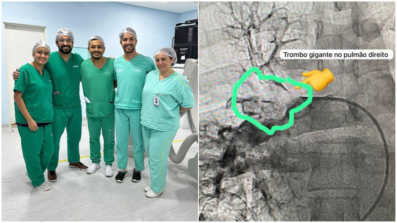 Hemodinâmica de Patos realiza dois procedimentos inéditos em menos de 1 semana por meio de Trombectomia Mecânica no Sertão da Paraíba