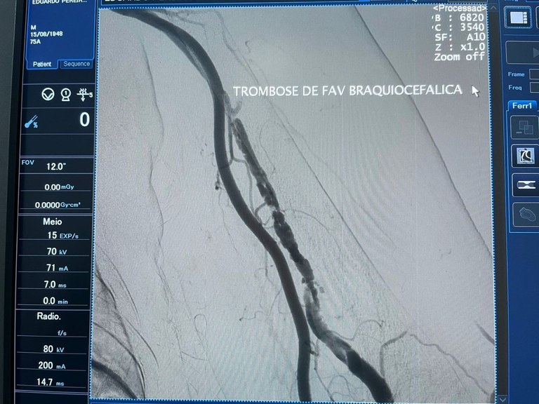 Hemodinâmica do Hospital de Patos realiza procedimento endovascular inédito em paciente renal