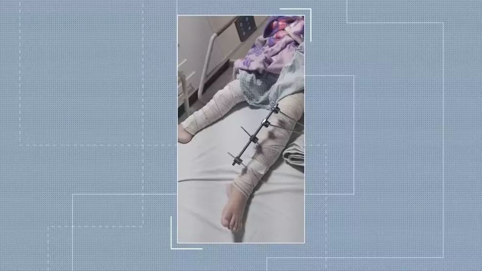 Criança vítima de erro médico em cirurgia estava com a perna correta identificada: ‘Era visível’, diz mãe