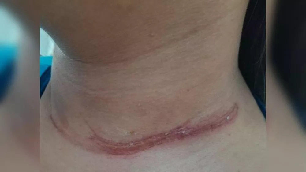 Fios de internet soltos continuam a causar acidentes em Patos e estudante universitária é atingida no pescoço e braço quando seguia de moto para a faculdade