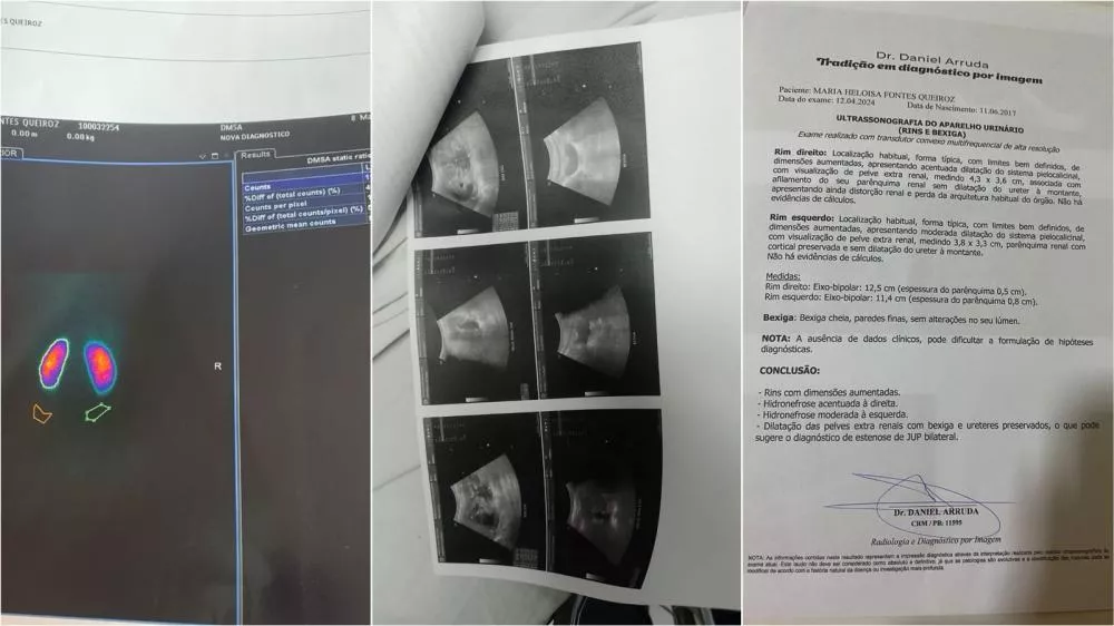 Pais de criança de 6 anos que realiza tratamento contra patologia renal grave reclamam de demora para consulta de retorno em JP e cobram agilidade no caso