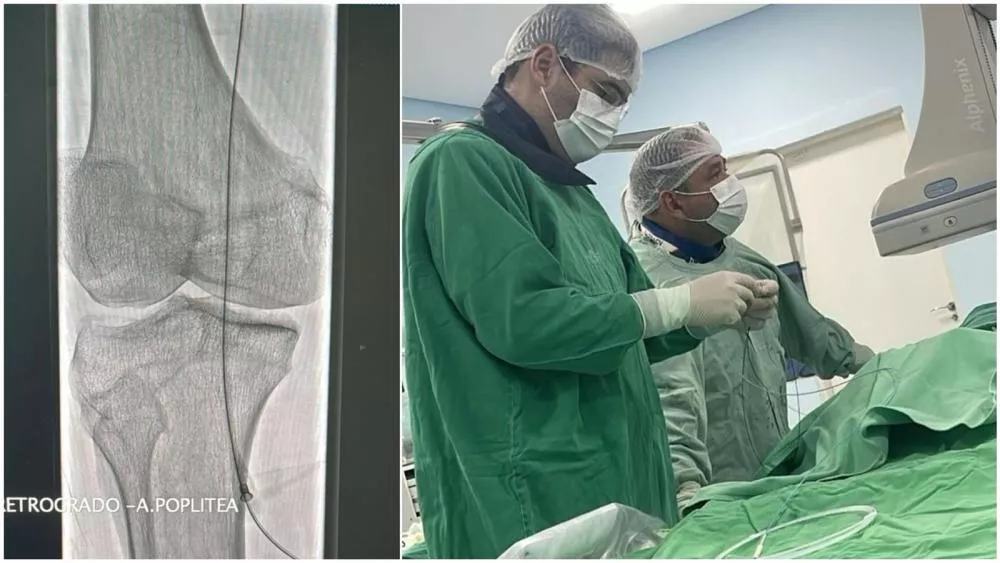 Procedimento inédito na Hemodinâmica de Patos evita amputação das pernas de paciente no Sertão da Paraíba