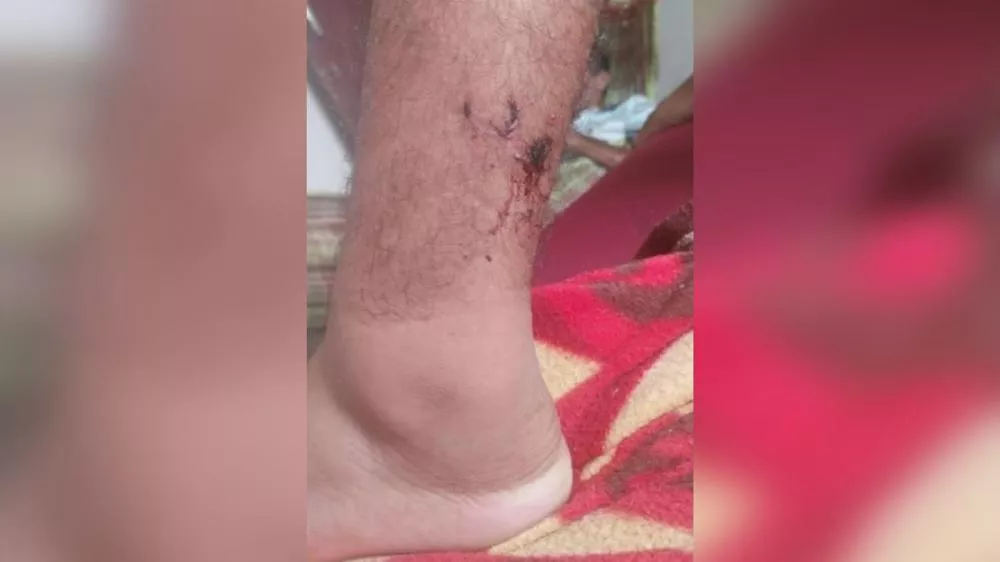 Adolescente é mordido por cachorro de rua pela segunda vez no Bairro Vitória, em Patos, e mãe desabafa