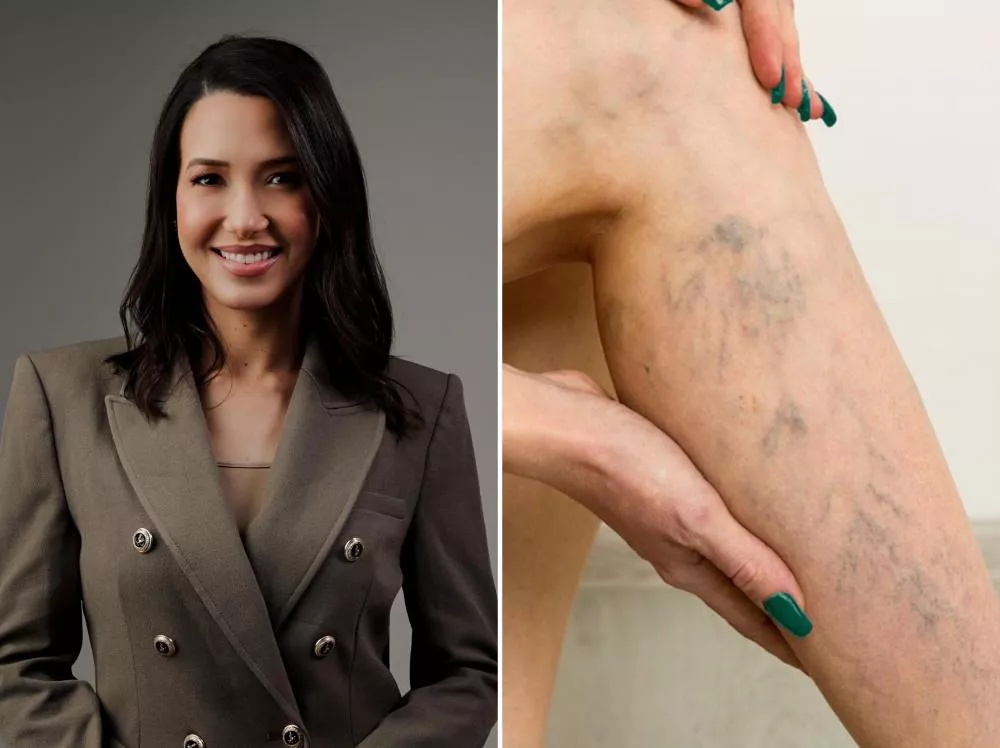 Tratamento de Varizes: Especialista Alerta para os Riscos de Não Tratar a Doença