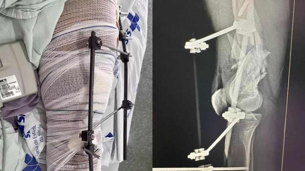 Jovem que sofreu fraturas em acidente de trânsito em Patos lança campanha solidária para custear tratamento