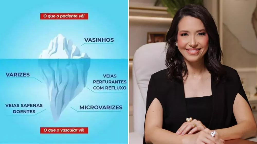 Varizes e vasinhos podem indicar problemas circulatórios mais graves, alerta Dra. Rhaíssa Assunção