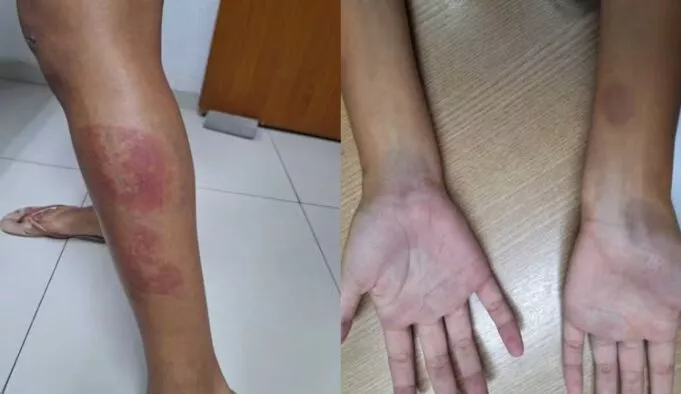 Mulher grávida é agredida a pauladas por dois irmãos, em Bayeux; suspeitos foram presos